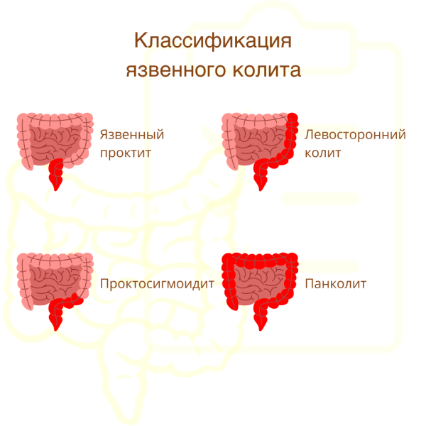 Классификация язвенного колита
